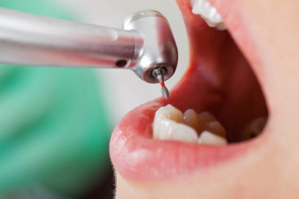 Best Emergency Wisdom Tooth Extraction in Lillington, NC